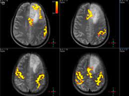 Neuroimaging funzionale che mostra differenze nella connettività cerebrale nell'autismo
